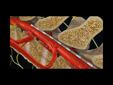 BIOTRONIK Neuro Acquires Spinal Cord Stimulation System from Soin Neuroscience